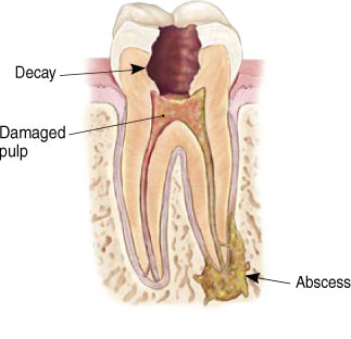 causes of need for root canal treatment