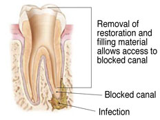 previous root filling removed from canals
