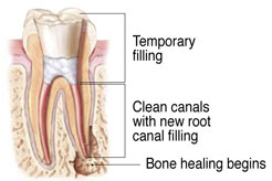 retreated root canals